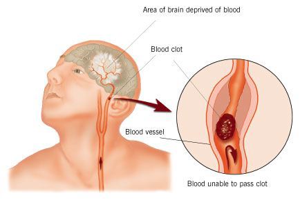  Blood Clots/Stroke